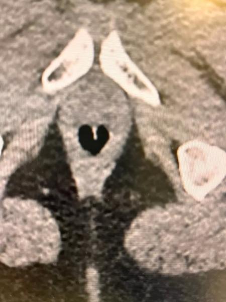 Врачи из Нижнекамска увидели в рентгеновских снимках пациентов сердечки